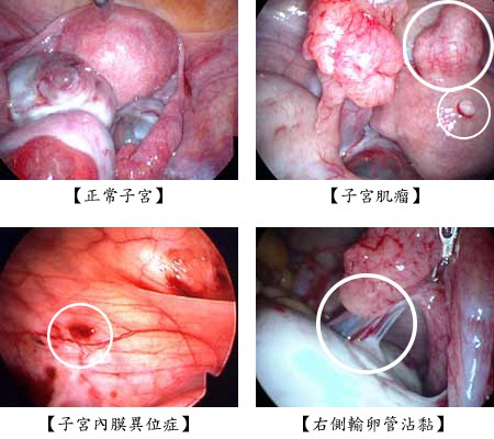 正常子宮/子宮肌瘤/子宮內膜異位症/右側輸卵管沾黏