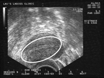 e-stork 月經期內膜