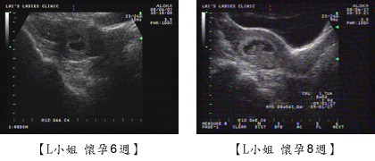e-stork L小姐懷孕6週即8週超音波